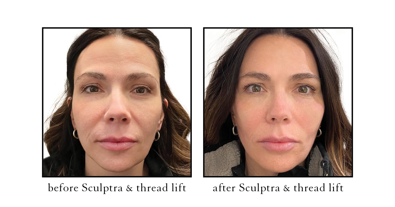 sculptra before and after