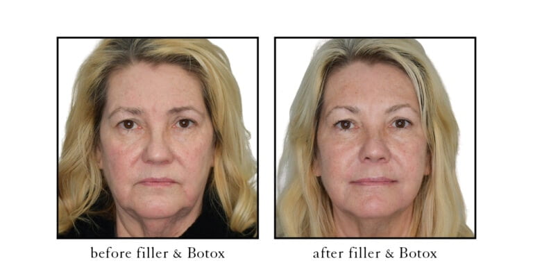 botox & filler before and after photos