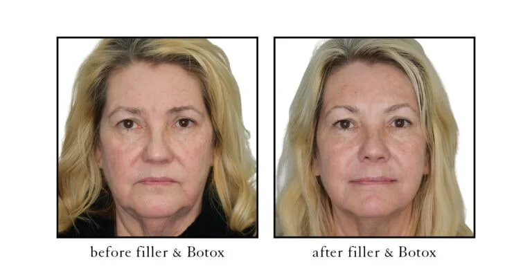 botox & filler before and after photos