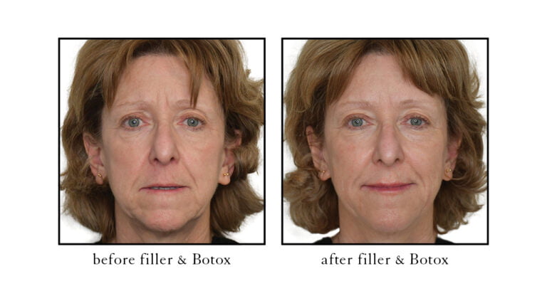 filler & botox before and after results