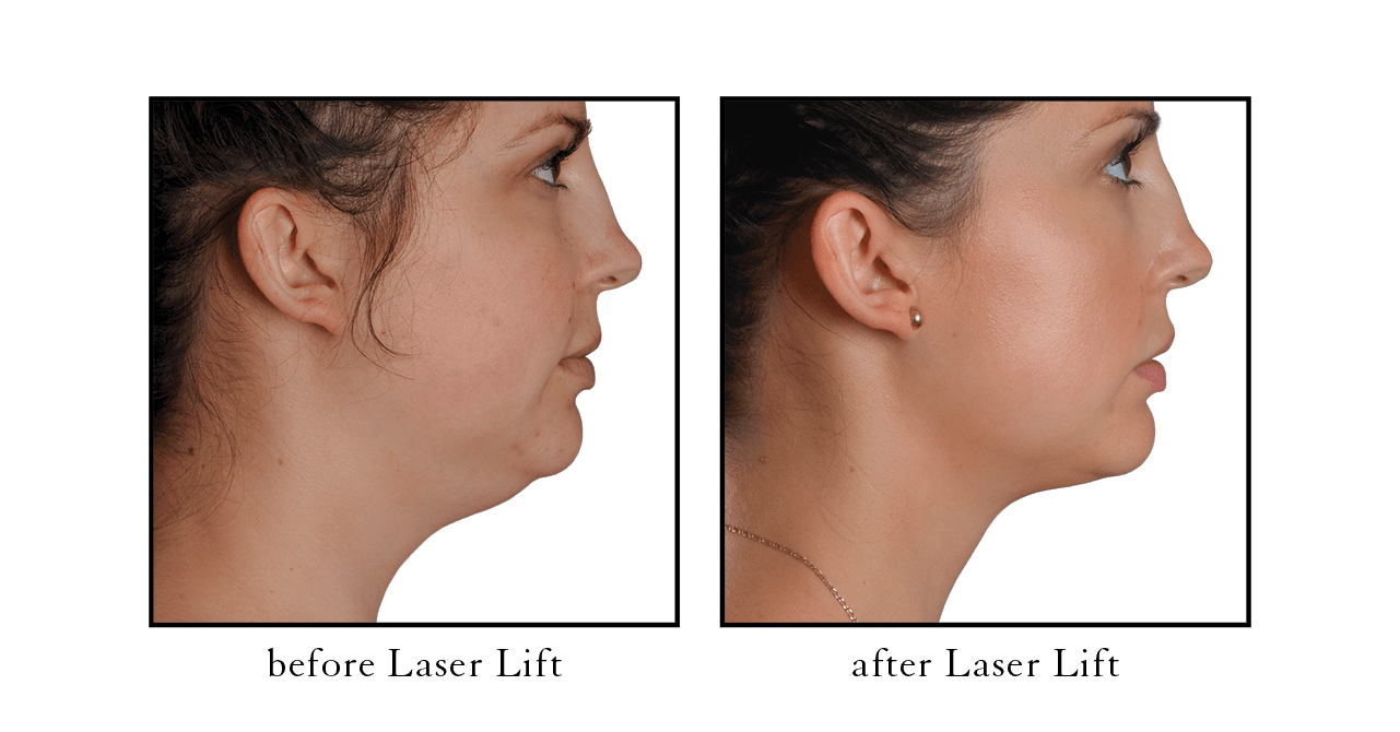 laser lift before & after result