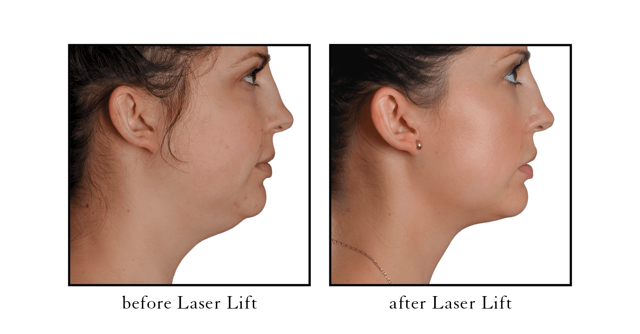 LIFTING FACIAL LASER