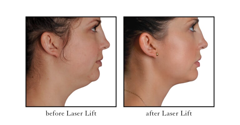 laser lift before and after photos