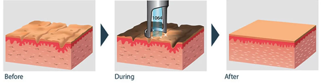 carbon laser peel carbon laser peel
