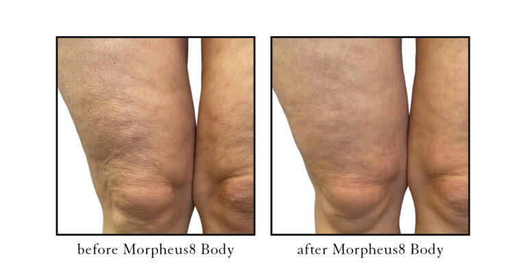 morpheus8 before and after photos