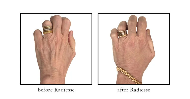 Radiesse hand rejuvenation before and after results showing restored volume and reduced tendon visibility at CSLC