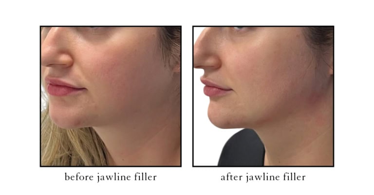 Before and after chin filler