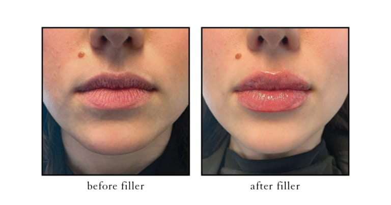 Lip filler before and after results