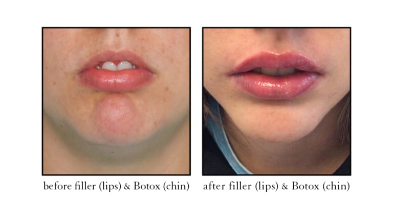 Lip filler before and after results