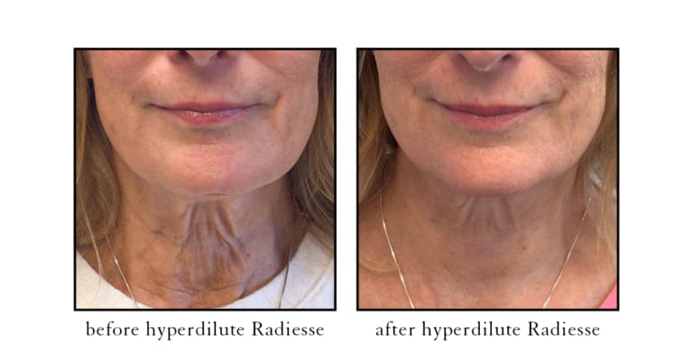 Radiesse filler for neck before and after results