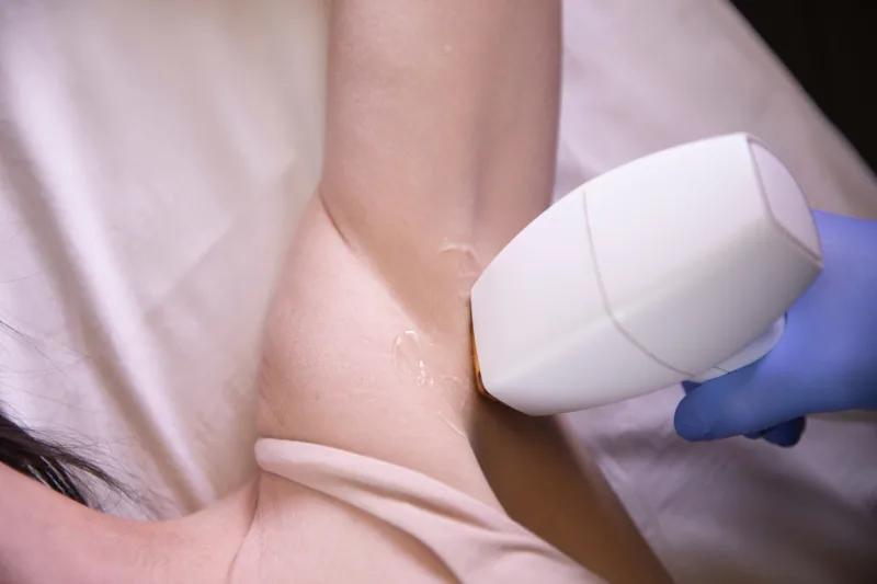 Laser hair removal. Ann Arbor, MI.