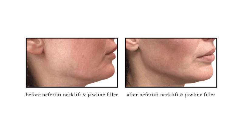 before after nerfertiti necklift at CSLC