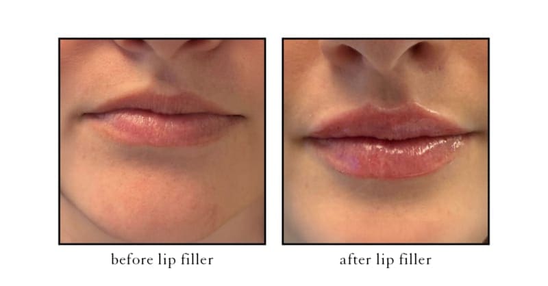 Before and after lip filler results with natural lip shape enhancement at CSLC