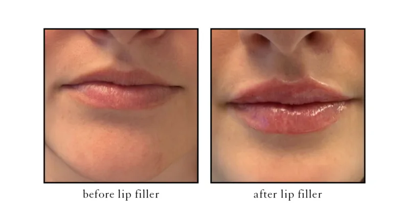 Before and after lip filler results with natural lip shape enhancement at CSLC