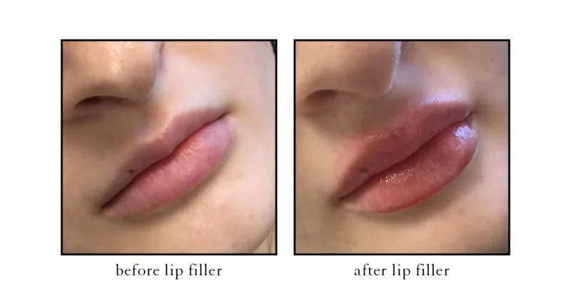 Lip filler before and after showing improved lip symmetry and definition at CSLC