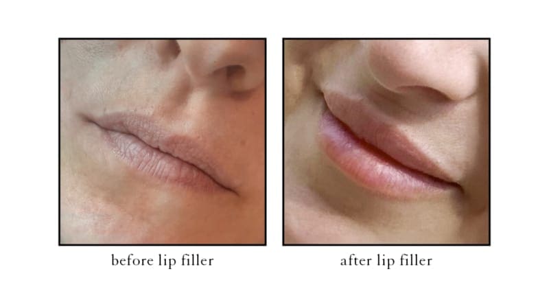 Lip filler before and after photo showing subtle volume enhancement at Cosmetic Skin and Laser Center