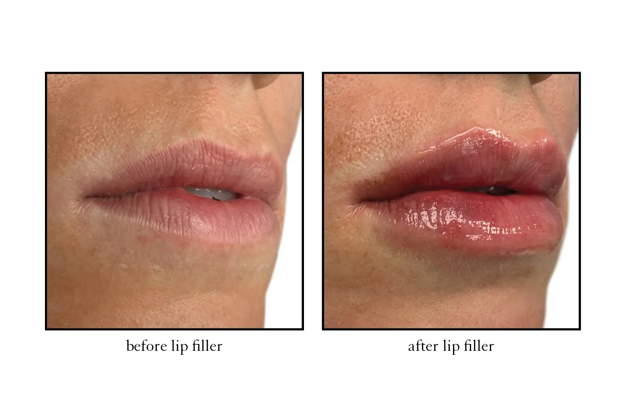 lip_filler lip_filler
