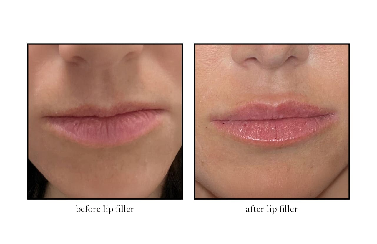 lip_filler2 lip_filler2