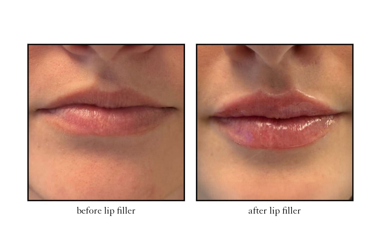 lip_filler3 lip_filler3