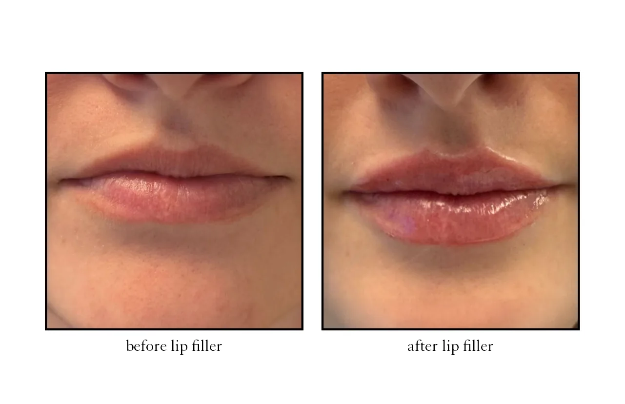 lip_filler3 lip_filler3