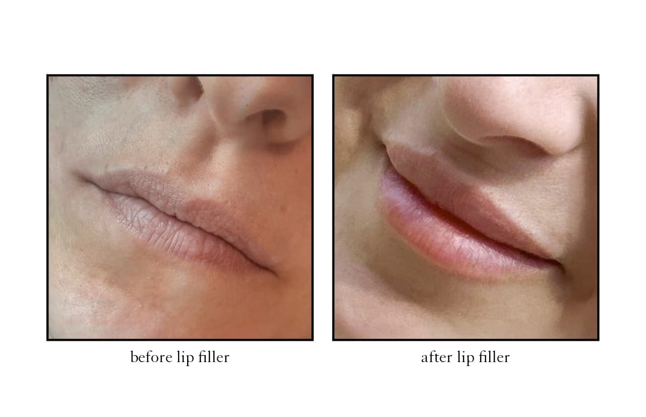 lip_filler4 lip_filler4