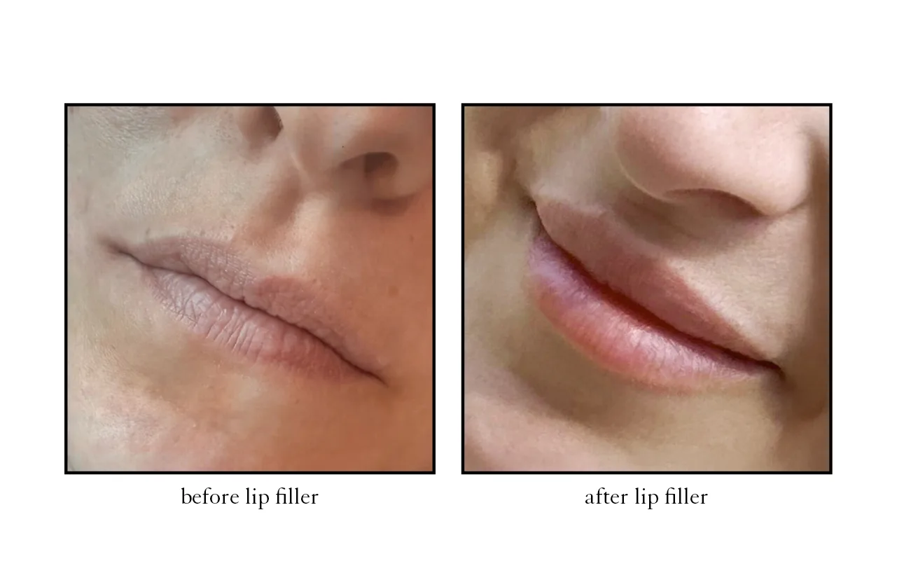 lip_filler4 lip_filler4
