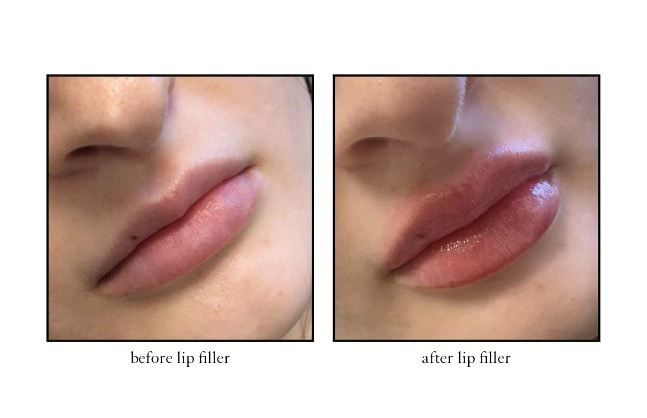 lip_filler5 lip_filler5