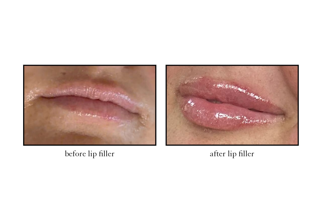 lip_filler_iPad lip_filler_iPad