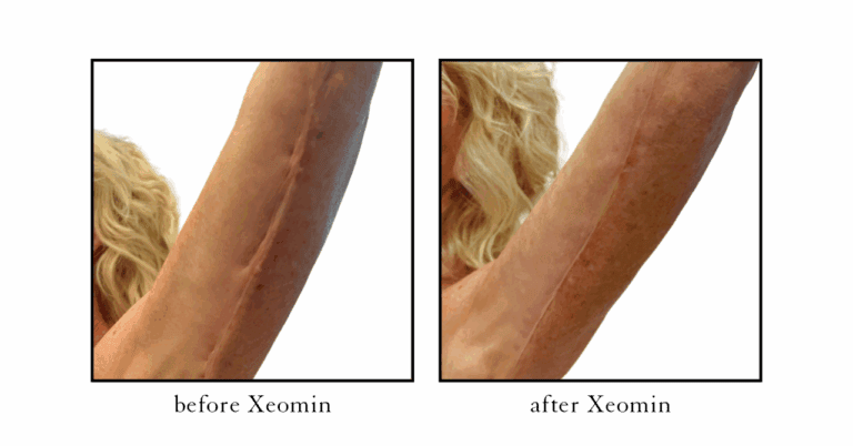 arm scar xeomin before after