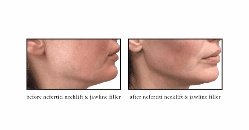 Before and after Nefertiti Neck Lift with Botox at Cosmetic Skin & Laser Center Chelsea MI