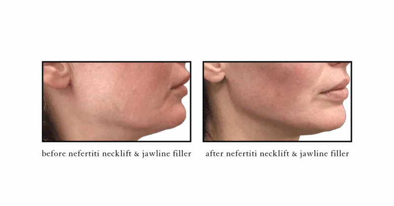 Before and after Nefertiti Neck Lift with Botox at Cosmetic Skin & Laser Center Chelsea MI