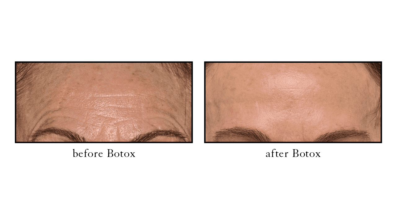 botox before and after hobe sound botox before and after hobe sound