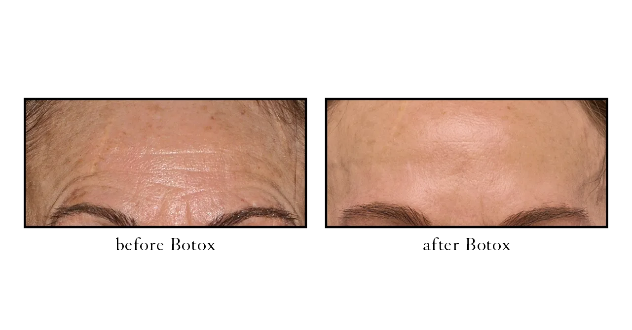 botox before and after downtown Naples, FL Botox before and after Port Royal Naples