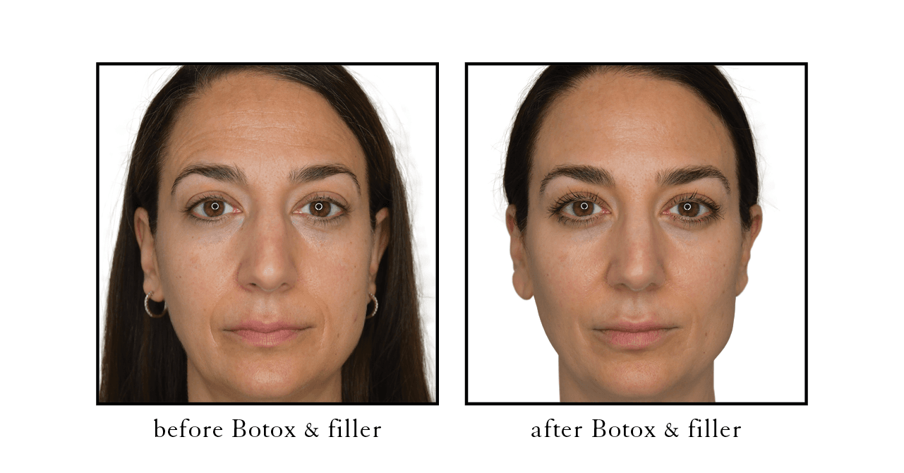 botox before and after palm beach gardens botox before and after palm beach gardens