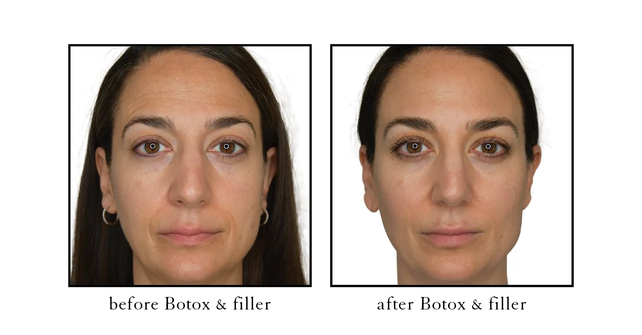 botox before and after downtown Naples, FL Crow’s feet treatment Downtown Naples