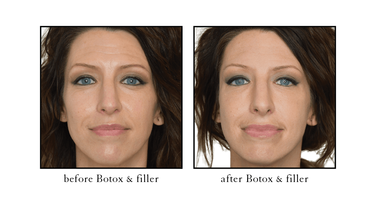 botox before and after palm beach botox before and after palm beach