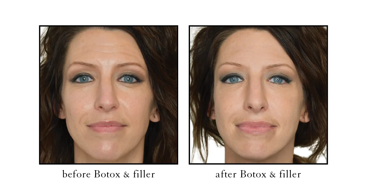 botox before and after downtown Naples, FL Lip flip before and after Old Naples