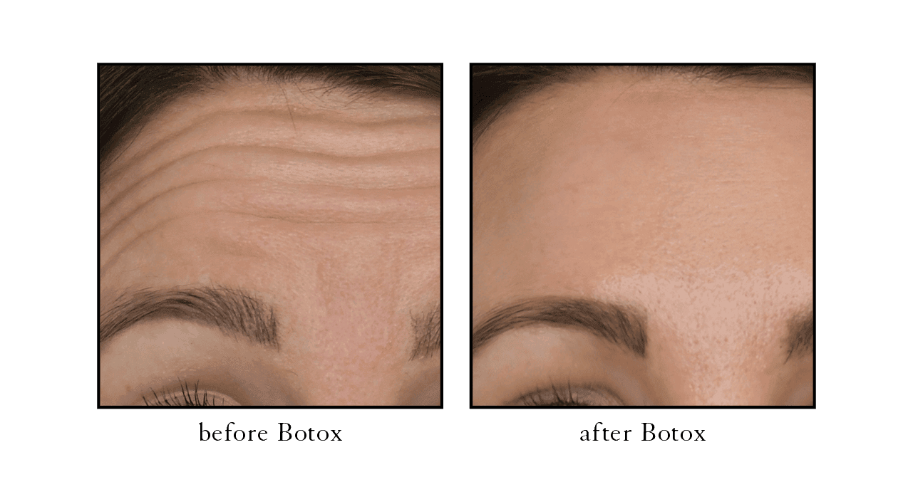 botox before and after wellington botox before and after wellington