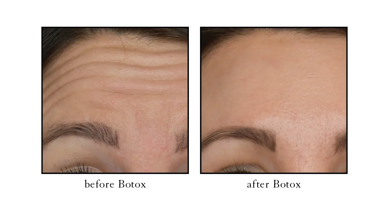 botox before and after downtown Naples, FL Nefertiti lift neck and jawline — near Naples Pier