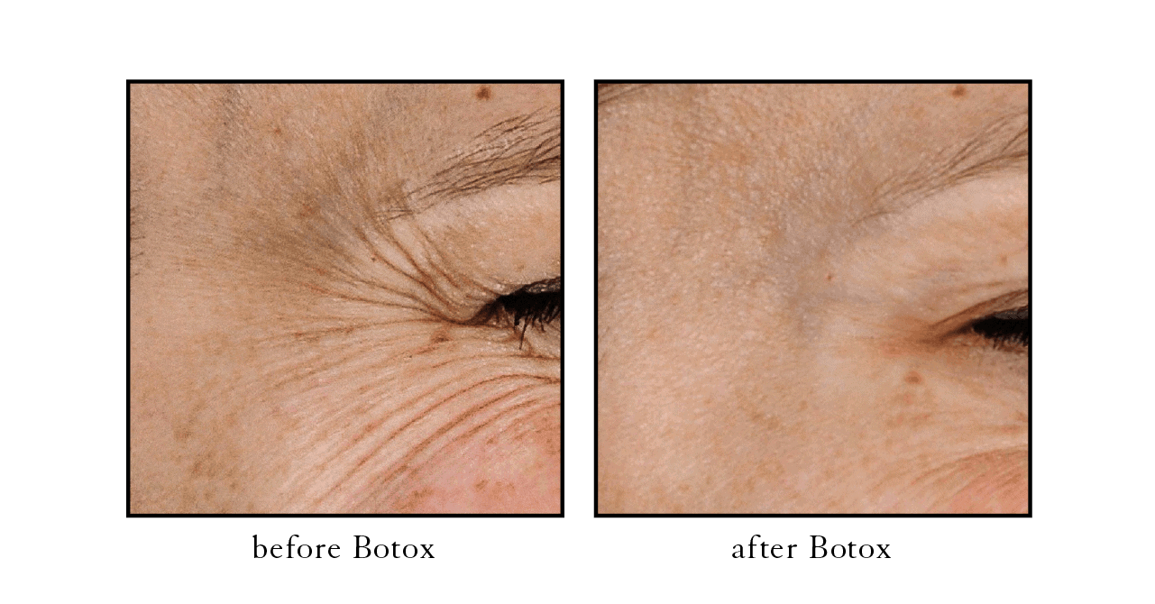 botox before and after Wellington botox before and after Wellington
