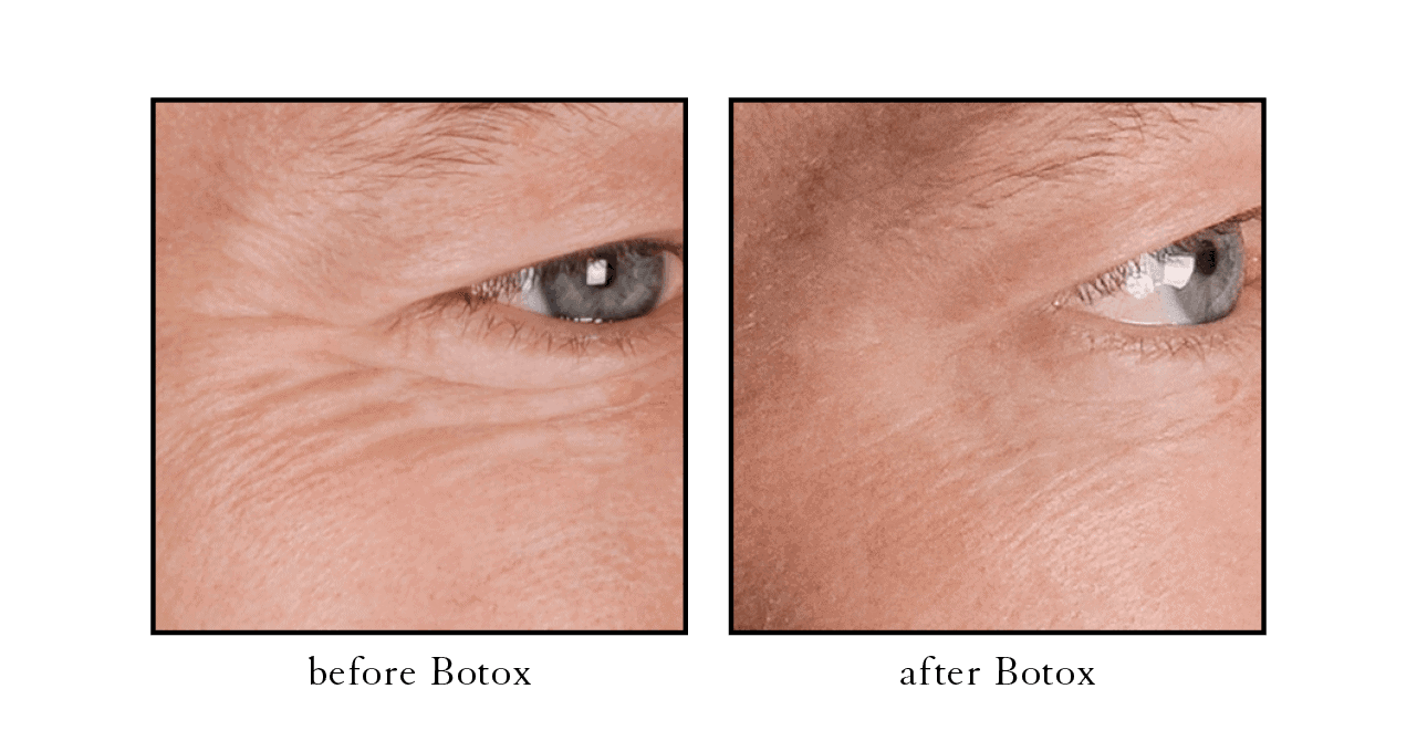 Crows feet Botox before and after Crows feet Botox before and after