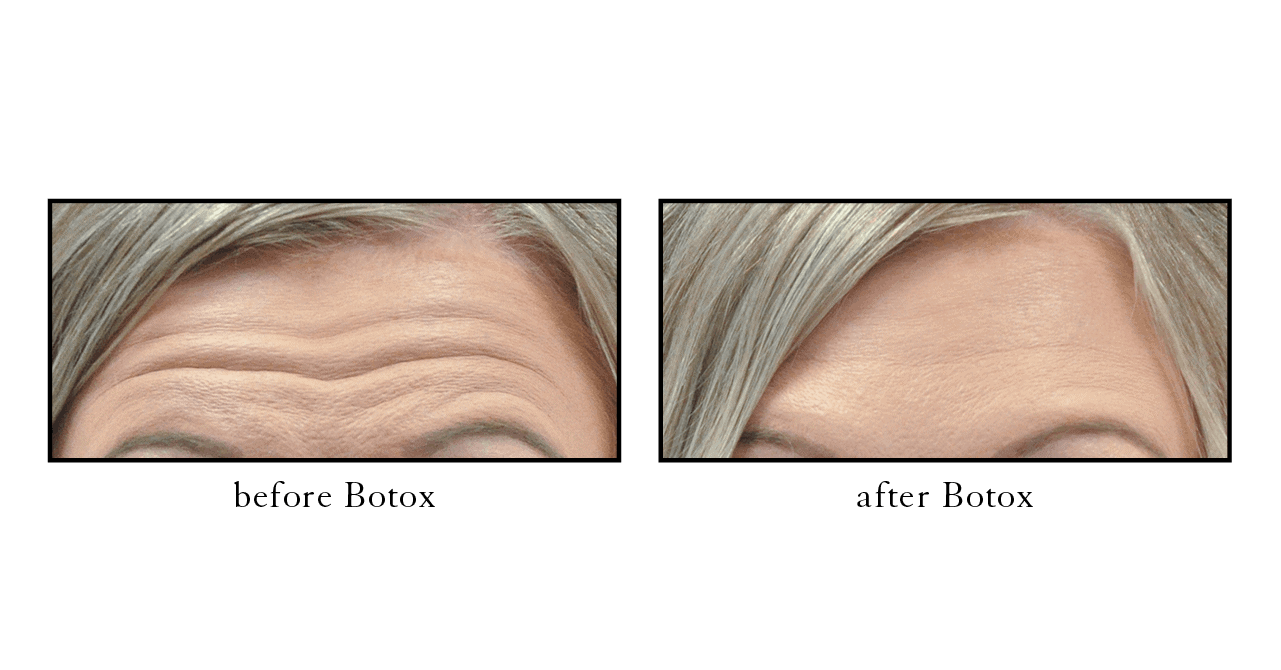 Vero Beach before and after Botox Vero Beach before and after Botox