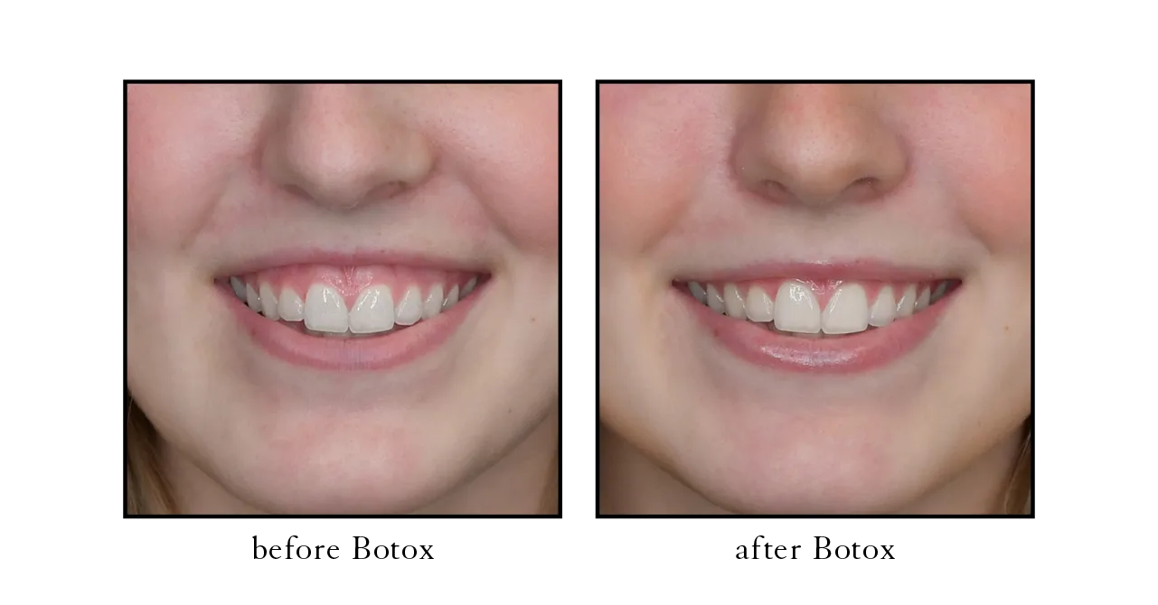 Botox before and after for gummy smile in Winter Park, FL