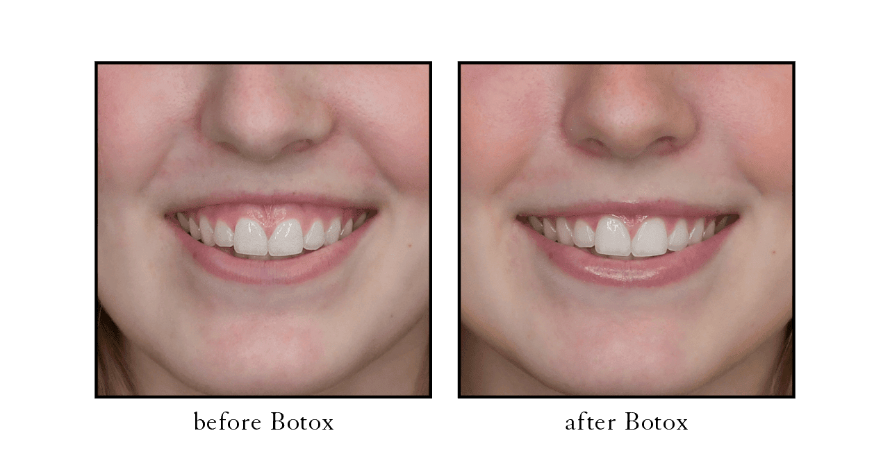 Before and after Botox Gummy Smile Wellington Before and after Botox Gummy Smile Wellington
