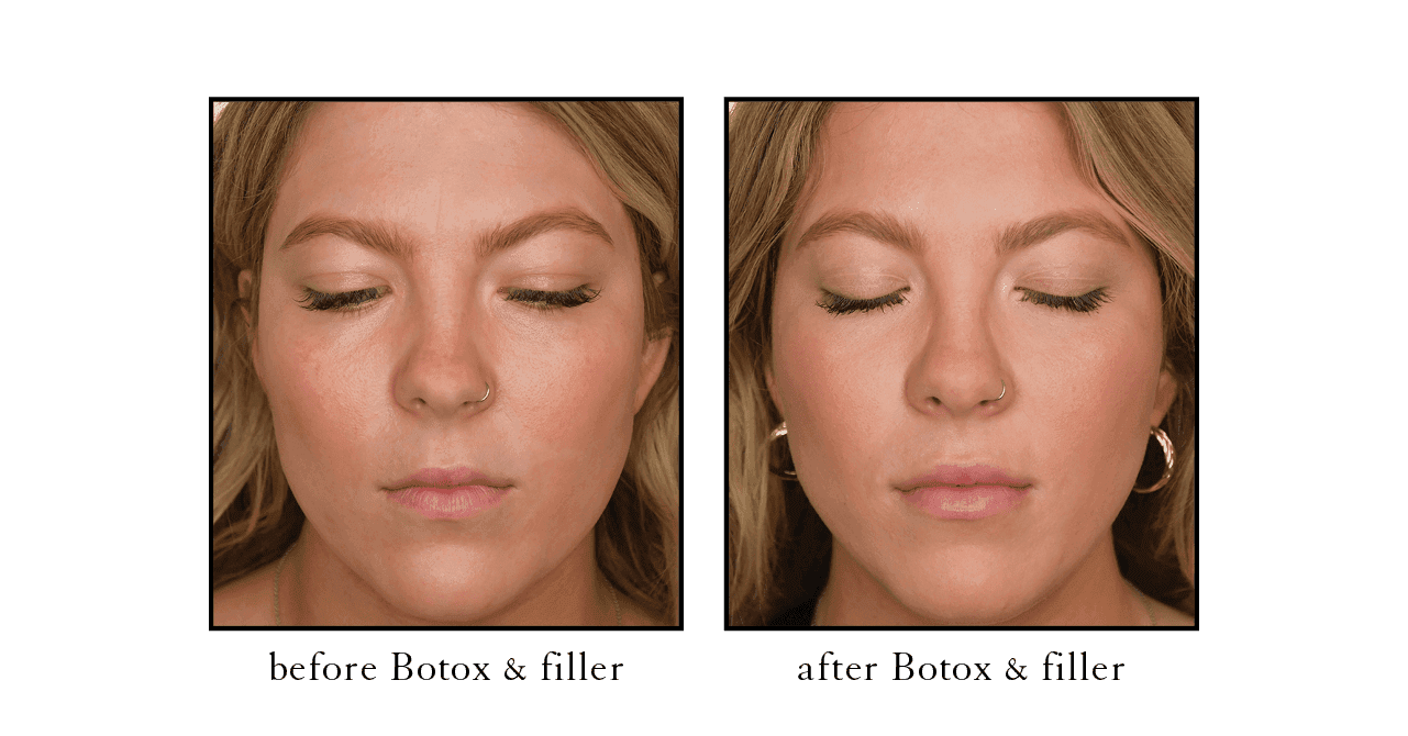 Full face before and after Botox Worth Avenue Full face before and after Botox Worth Avenue