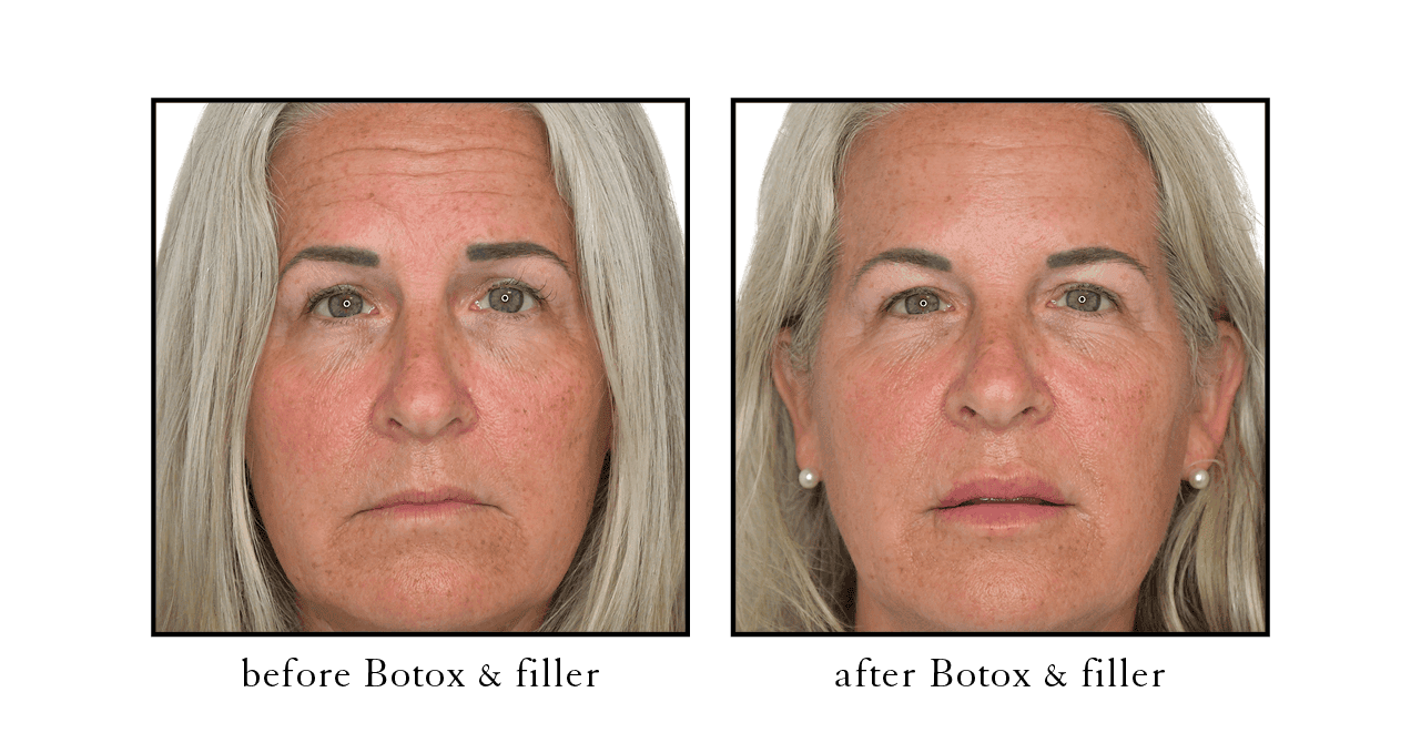 Botox & filler before and after Vero Beach, FL Botox & filler before and after Vero Beach, FL
