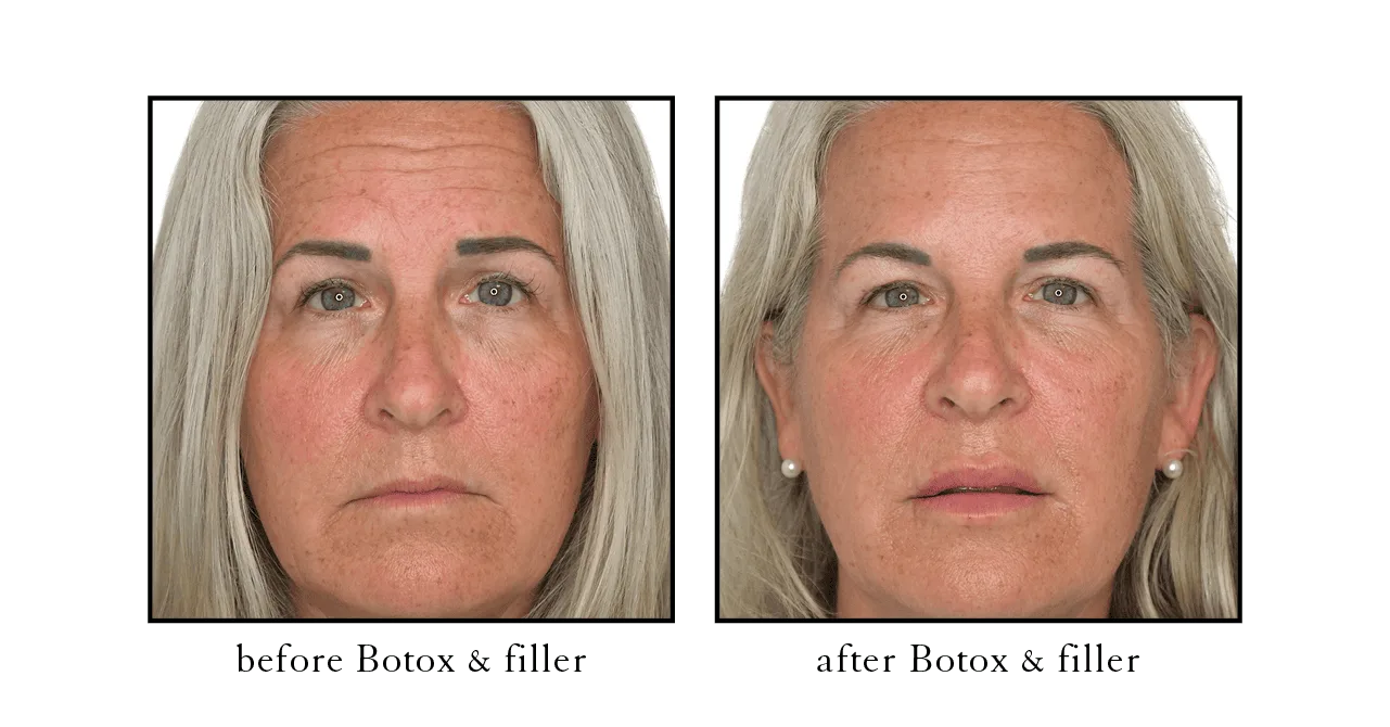 Full face Botox before and after West Palm Beach, FL