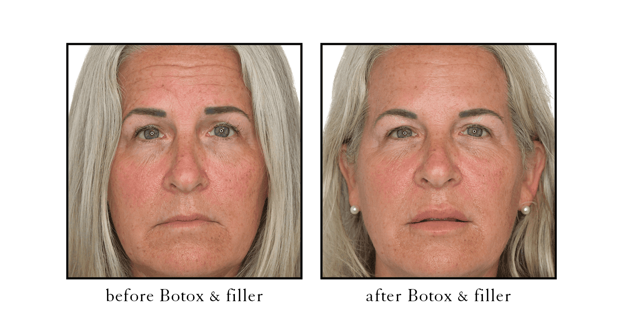 Full face Botox before and after Lake Mary, FL Full face Botox before and after Lake Mary, FL