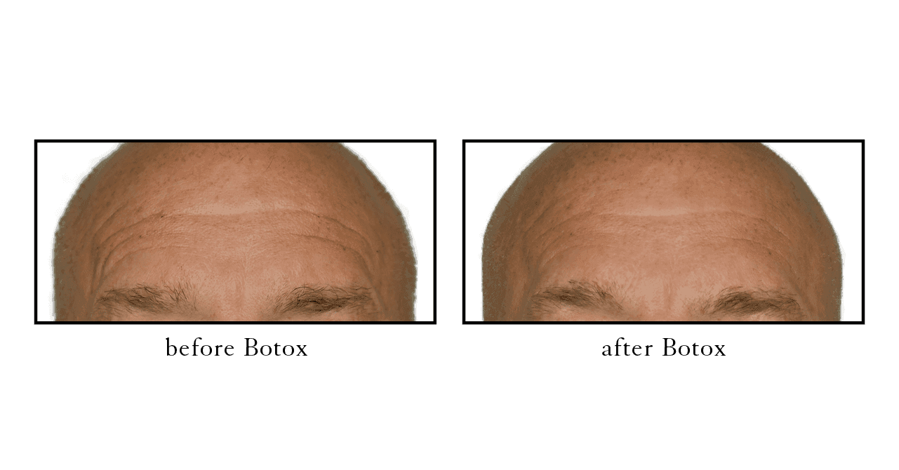 Men Botox before and after Lake Mary, FL Men Botox before and after Lake Mary, FL