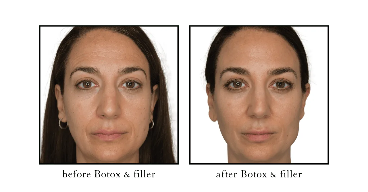 Full face botox before and after Winter Park, FL